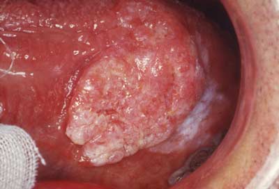 Ung thư miệng - Nguyên nhân và cách phòng ngừa