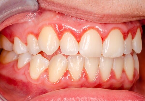 Covid-19 và chăm sóc răng miệng