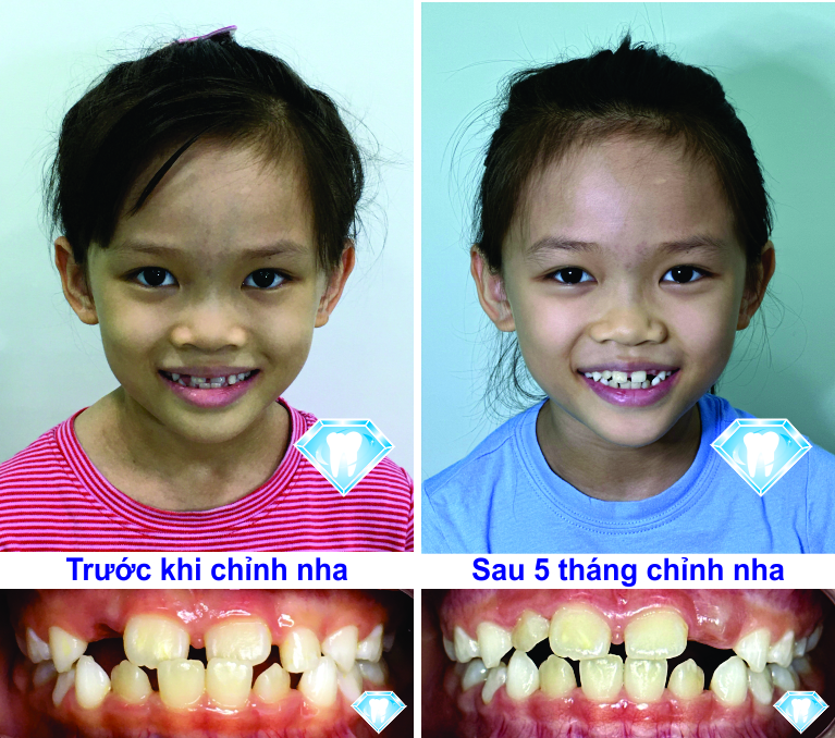 Invisalign first – Xu hướng mới trong niềng răng cho trẻ