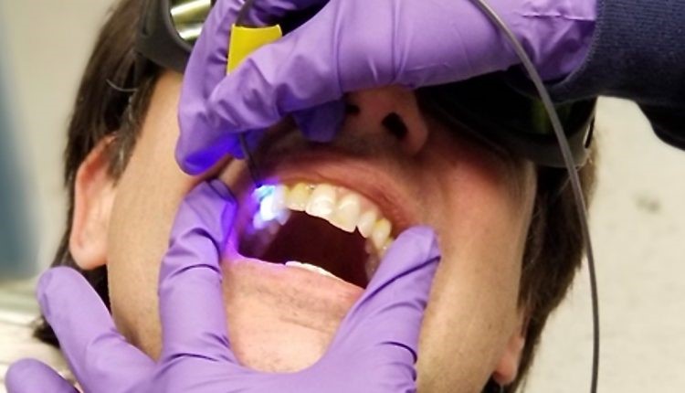 Máy đo độ pH do Đại học Washington (UW) nghiên cứu có thể phát hiện sâu răng