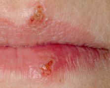 Nha khoa Tân Hoàn Mỹ - Trước khi điều trị herpes