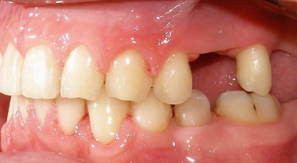 Sự di chuyển răng thay thế cho ghép xương